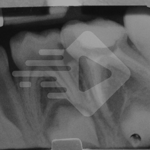 Tratamento endodôntico em dentes decíduos: Aprimorando a técnica de pulpectomia para melhores resultados