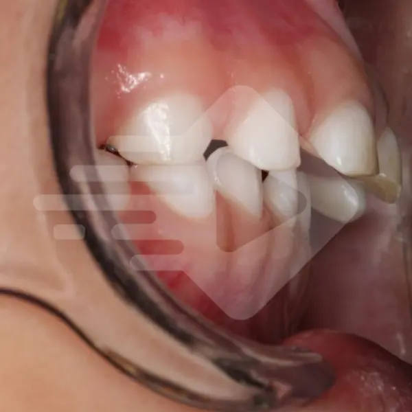 O overjet aumentado representa um risco ao trauma dental? O overjet aumentado representa um risco ao trauma dental?