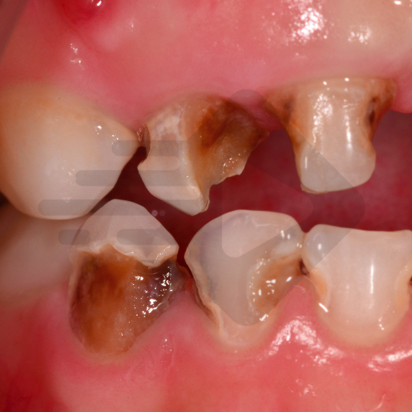 Remoção seletiva do tecido cariado com dentina amolecida