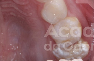 Impacção do primeiro molar superior permanente