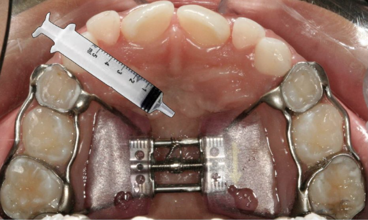 Como orientar seu paciente nos cuidados com aparelho expansor fixo