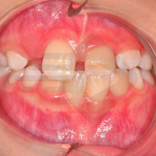 O trauma no dente decíduo prejudicou o dente permanente?
