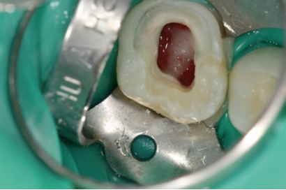 Diagnóstico da condição pulpar e a pulpectomia em dentes decíduos