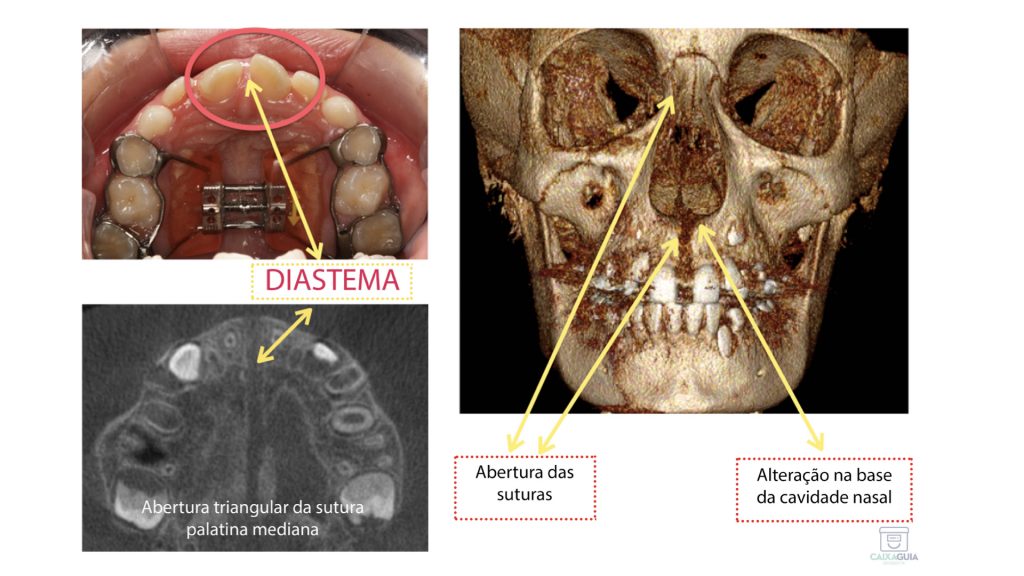 Expansão maxilar: quando é necessário? - Academia da Odontologia