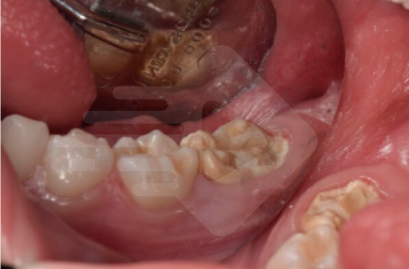 HMI: a famosa Hipomineralização Molar-Incisivo