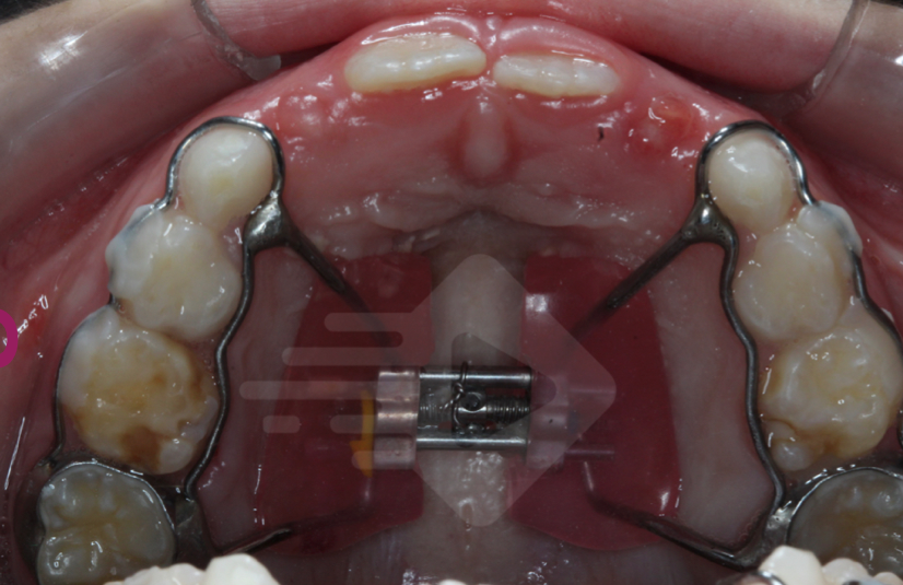 Características do aparelho expansor tipo Haas modificado