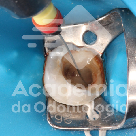 E-book Endodontia mecanizada em dentes decíduos