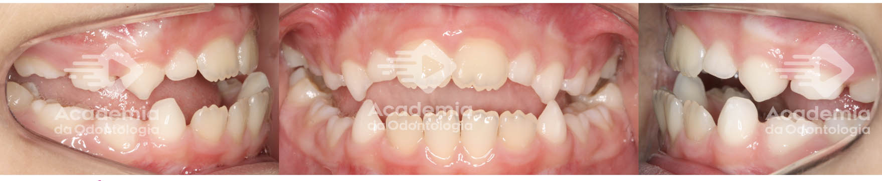 Expansão maxilar: entenda os benefícios da expansão maxilar no tratamento da Classe I, Classe II e Classe III