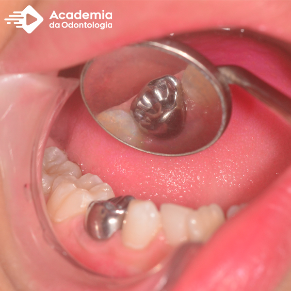 Qual a melhor conduta diante do tratamento da cárie em dentes decíduos?