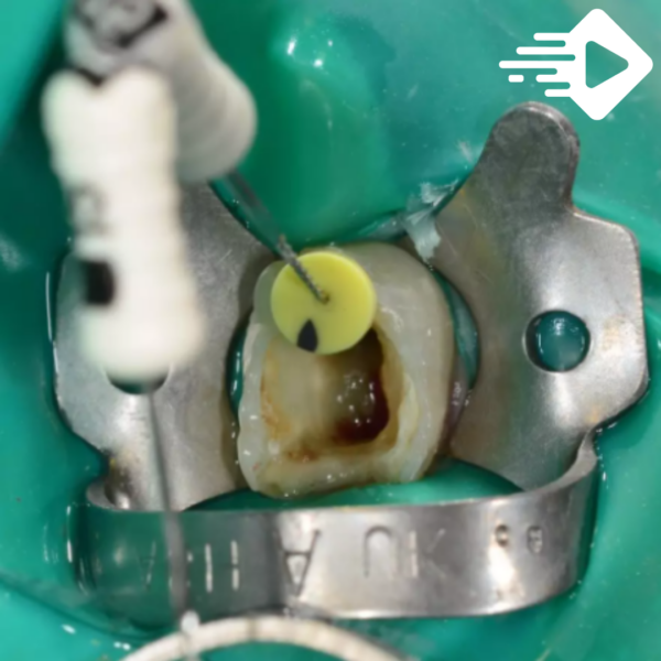 Tratamento endodôntico manual x mecanizado: O que você precisa saber na conduta em dentes decíduos