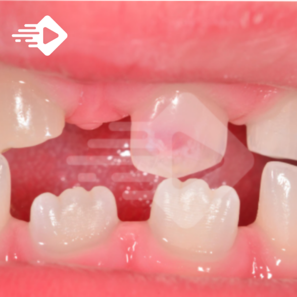 Alteração de cor da coroa após traumatismo em dente decíduo: o que significam os diferentes tipos de cor?