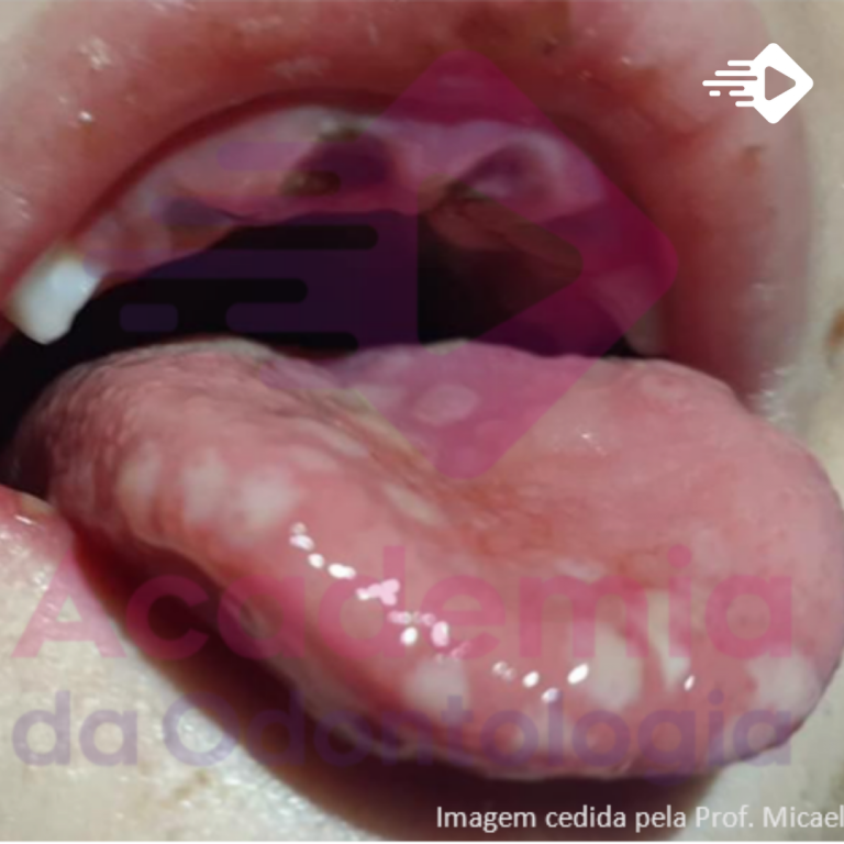 Gengivoestomatite Herpética Aguda: Como abordar essa patologia bucal?