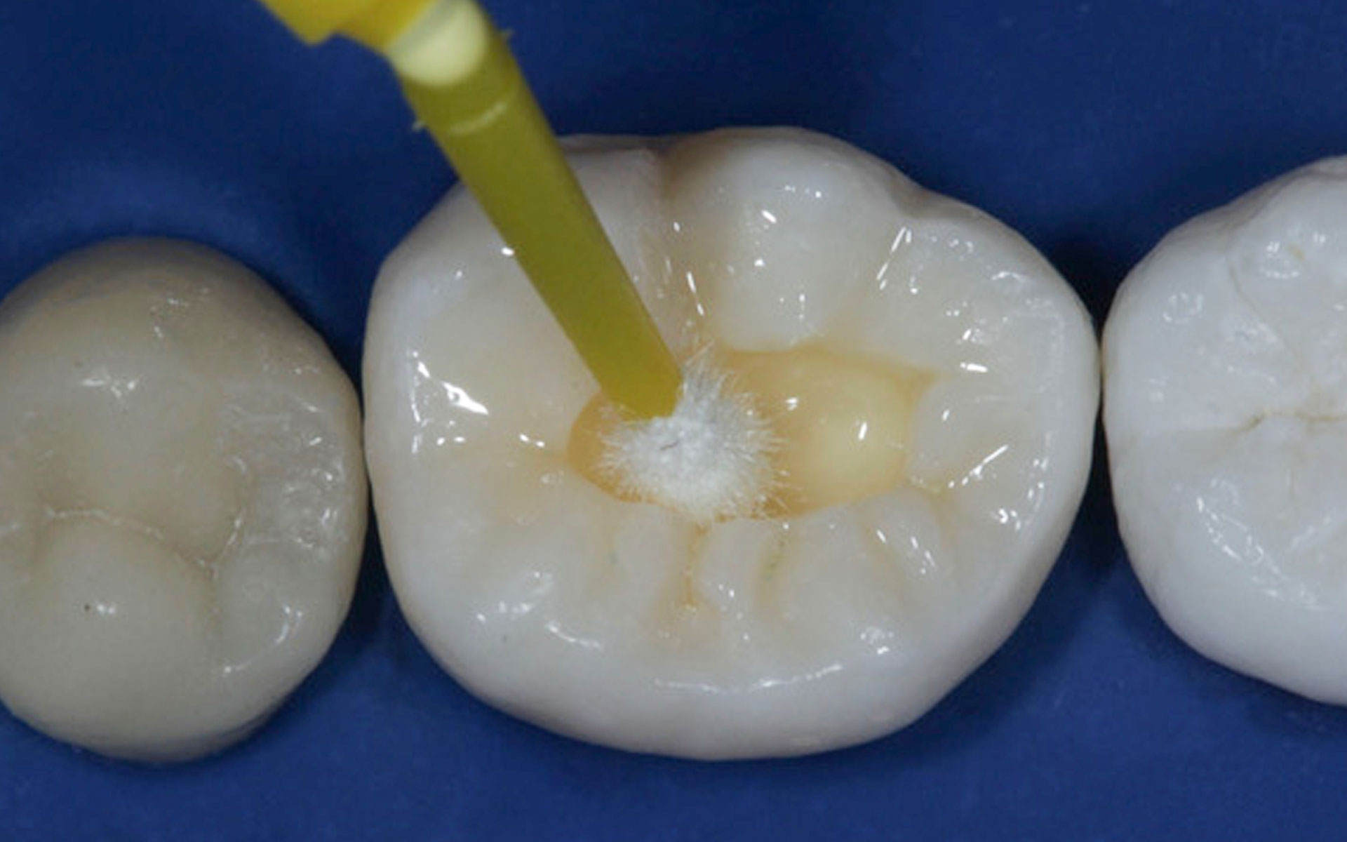 Materiais Dentários