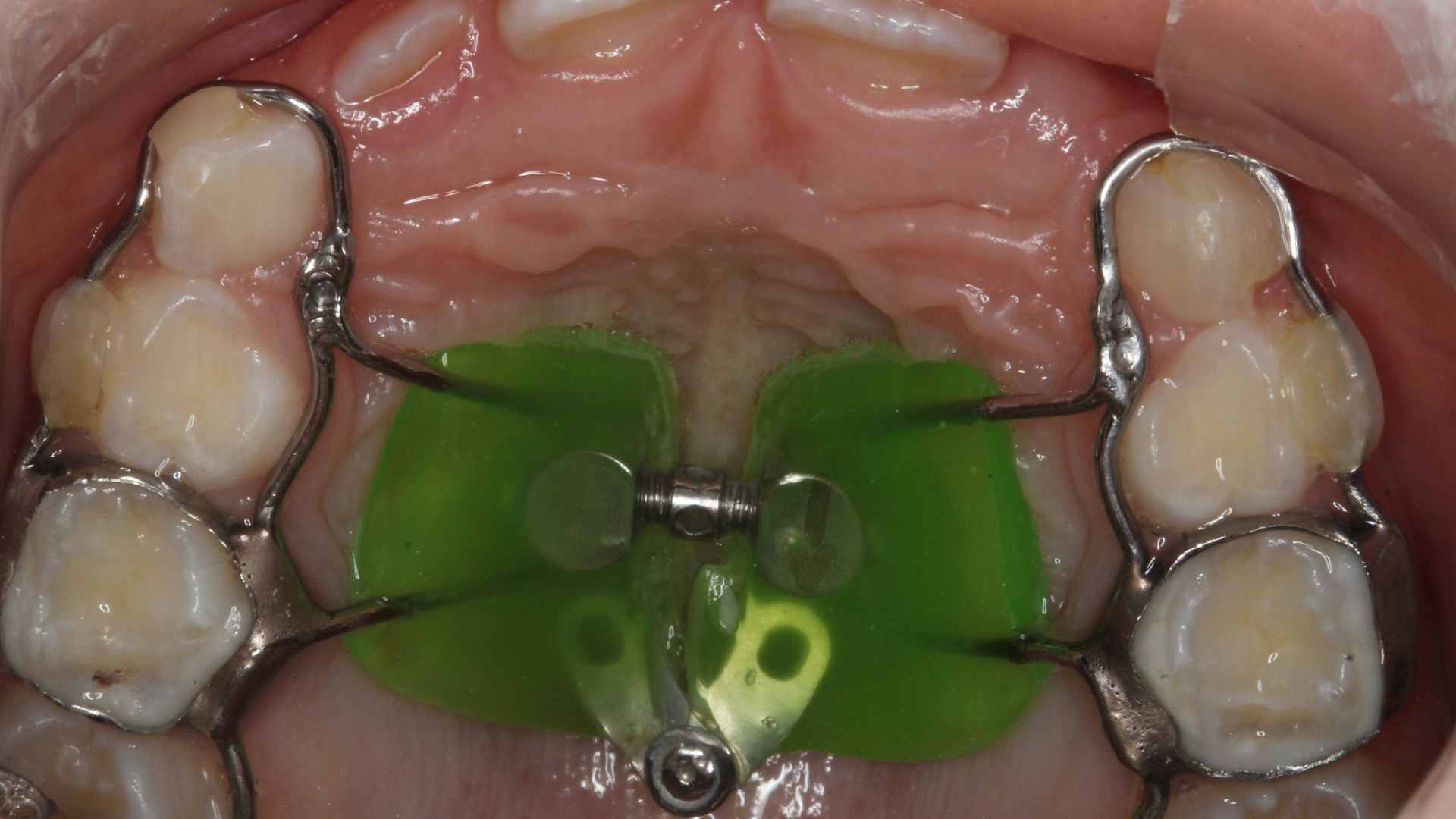 Módulo 05 – Expansão rápida da maxila na dentição decídua e mista