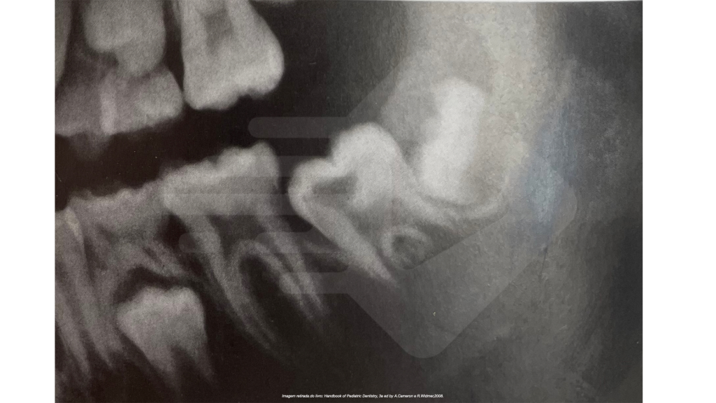 reabsorção radicular e coronal