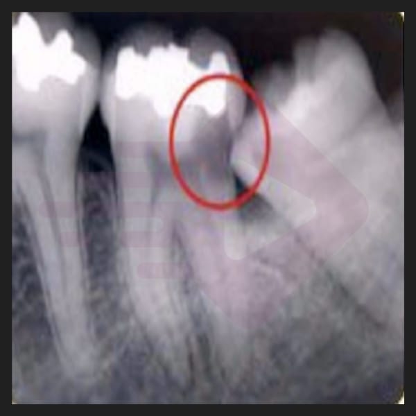 Quando indicar a remoção dos terceiros molares?