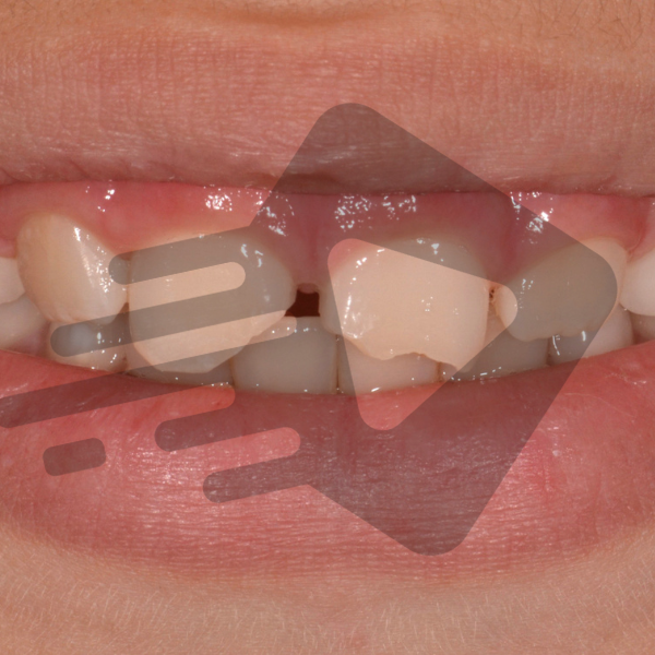 Como tratar dentes anteriores fraturados ?