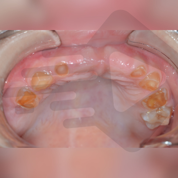 Dentinogênese Imperfeita ou cárie?