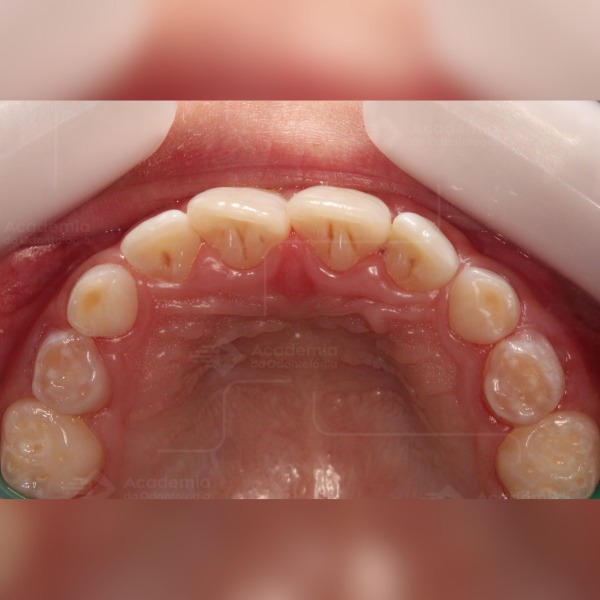 Erosão dental na Odontopediatria, da etiologia ao diagnóstico e a conduta clínica!