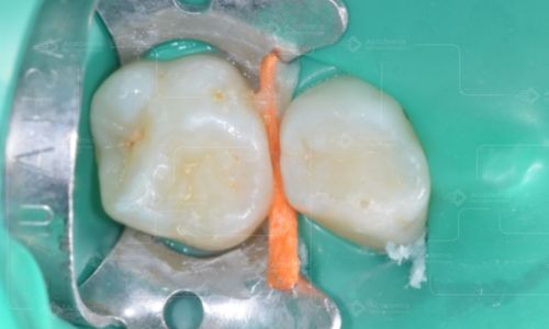Resina fluida em restaurações ocluso-proximais de dentes decíduos – vale a pena? Já te ensinaram essa tática?
