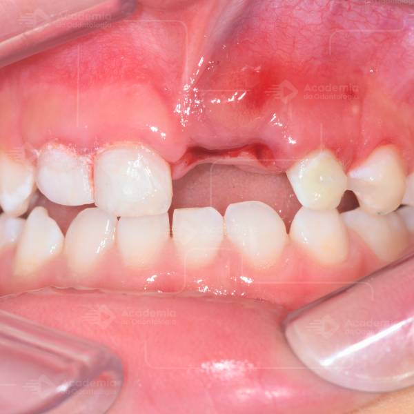 Impacto de traumas em dentes de leite sobre a dentição permanente