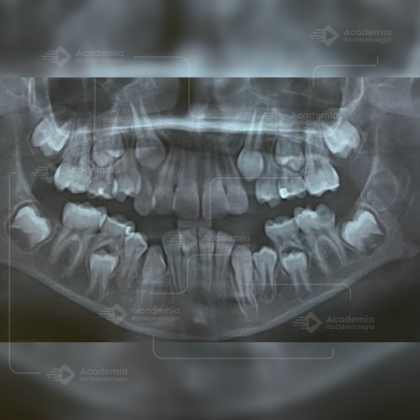 🦷 Extração precoce do primeiro molar permanente: por que e para quê? E ainda, o que será da erupção do segundo molar permanente?