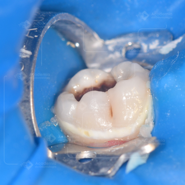 Ei, Odontopediatra: Dique de Borracha na odontopediatria é ALIADO OU VILÃO?