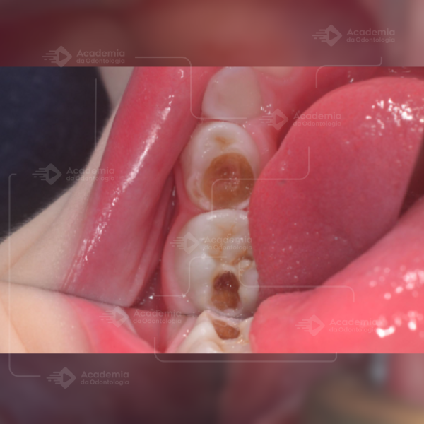 Sedação em Odontopediatria: Segurança, Tipos e Novas Normas para os consultórios odontológicos